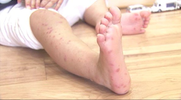 手足口病5週ぶりに減少　1医療機関あたり9.82人　全国的流行のマイコプラズマ肺炎は県内でも増加傾向　手洗いなどの感染予防対策を呼びかけ　|　SBC NEWS | 長野のニュース | SBC信越放送