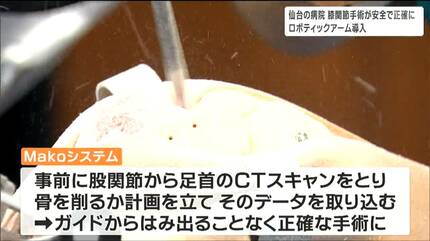 入院期間の短縮であったりリハビリの進み方がかなり早い」ロボテック