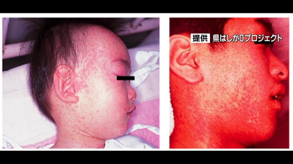 【速報】沖縄県で今年初のはしか患者を確認　20代男性、県外から帰沖後に発症