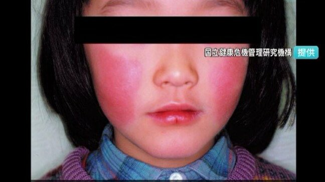 「りんご病」は増加　「百日せき」は微減　いずれも依然高い状況で推移　長野|TBS NEWS DIG