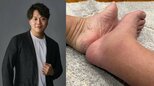 【エハラマサヒロ】「痛風は地獄って伝えなきゃ」大きく腫れた右足の写真を投稿　フォロワー反応「ゾッとします」|TBS NEWS DIG