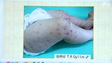 手足口病「警報レベル」に 乳幼児を中心に感染拡大 新型コロナへの対策が関係か 従来とは違った症状も=静岡 | 静岡のニュース | SBSNEWS | 静岡放送