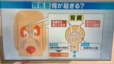 45キロあった体重は38キロに “紅麹サプリ”摂取後に体調悪化の40代女性 診断名は…「ファンコニー症候群」|TBS NEWS DIG