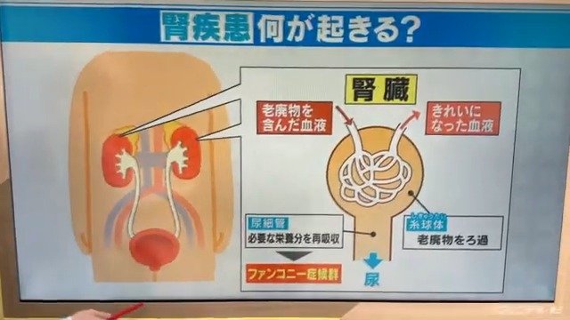 45キロあった体重は38キロに  “紅麹サプリ”摂取後に体調悪化の40代女性　診断名は…「ファンコニー症候群」|TBS NEWS DIG