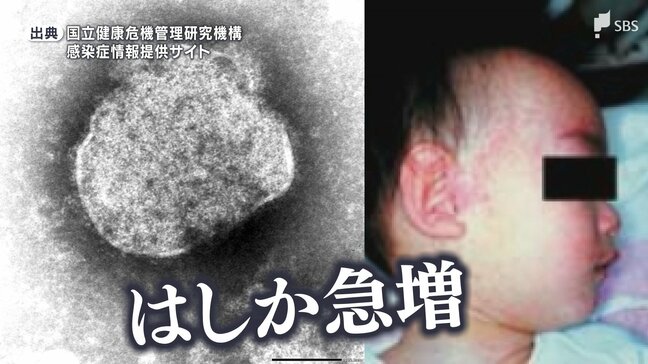 国内で急増の「はしか」感染するとどうなる？ 感染力はコロナの5倍 唯一の対抗策は「ワクチン接種」=静岡|TBS NEWS DIG