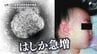 国内で急増の「はしか」感染するとどうなる？ 感染力はコロナの5倍 唯一の対抗策は「ワクチン接種」=静岡　|　静岡のニュース | SBSNEWS | 静岡放送