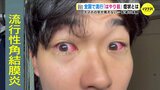 引っかかれたような痛み スマホの光も苦痛に「はやり目」引き起こす 「アデノウイルス」強い感染力にドアノブでは1か月以上も生き残るしつこさも|TBS NEWS DIG