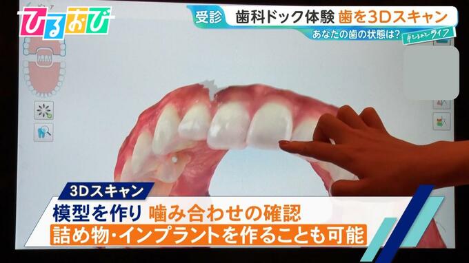 2人に1人が『歯周病』…予防に有効な「歯科ドック」って何をする？歯科医が教える簡単ケア術【ひるおび】|TBS NEWS DIG