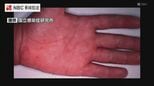 手足口病の患者数が警報レベル 長崎県内では2年ぶり 口内や手のひら、足裏などに水疱性の発疹できる感染症「乳幼児のおむつ交換後は手洗いを」|TBS NEWS DIG