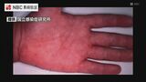 手足口病の患者数が警報レベル 長崎県内では2年ぶり　口内や手のひら、足裏などに水疱性の発疹できる感染症「乳幼児のおむつ交換後は手洗いを」|TBS NEWS DIG