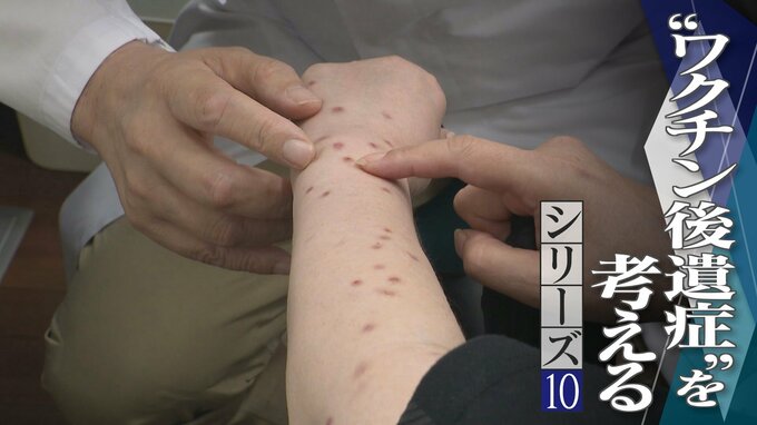 腕や足に赤い“水ぶくれの跡” 新型コロナワクチン接種後 皮膚に湿疹が…医師は患部にワクチン由来の“ある物質”を発見【“ワクチン後遺症”を考える シリーズ10】|TBS NEWS DIG