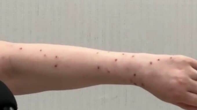新型コロナワクチン接種後に「倦怠感」「皮膚炎」に苦しむ50代女性　国やファイザー社に損害賠償を求め提訴　ワクチンの有害性も立証へ|TBS NEWS DIG