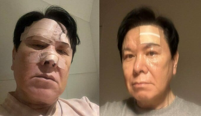 先月、転倒し大けが・鼻を骨折　【 三ツ矢雄二 】 「だんだん回復して来ました。まだ、頭はジンジン痛いけど。おでこの左側にでっかい傷跡が残ってます」　現況を報告|TBS NEWS DIG