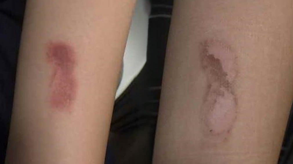 その使い方大丈夫？冷却グッズの使用で皮膚トラブル急増　保冷剤で「凍傷」も…医師が指摘する落とし穴とは