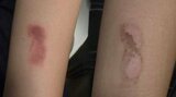 その使い方大丈夫?冷却グッズの使用で皮膚トラブル急増 保冷剤で「凍傷」も…医師が指摘する落とし穴とは|TBS NEWS DIG
