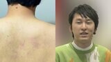 背中がアザだらけに…「宮下草薙」・宮下さん　愛車を守るため「全ての雹（ひょう）を背中で」|TBS NEWS DIG