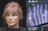 【 梅宮アンナ 】 「足の小指骨折　全治５週間」「痛い　痛い」　ＳＮＳで明かす|TBS NEWS DIG