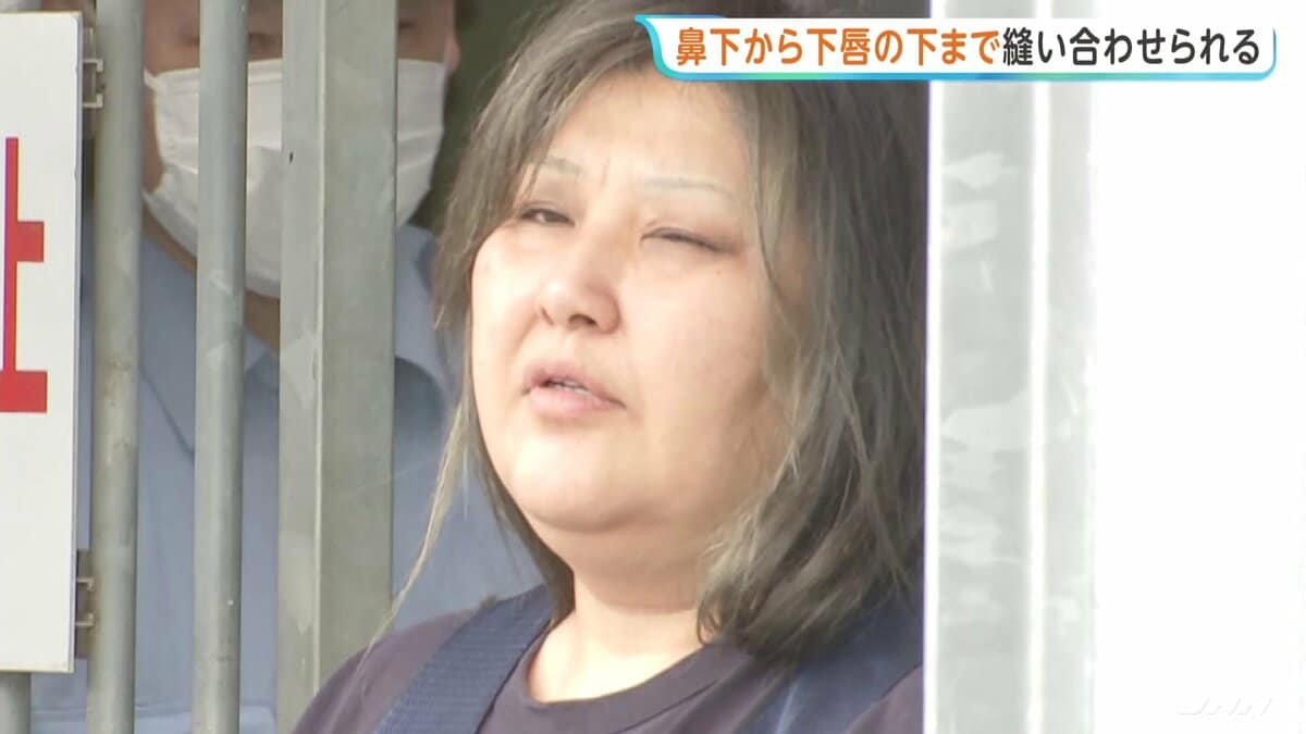 鼻の下から下唇の下までを口の中に糸を通す形で縫われる　女性の唇を縫い付け49歳女…