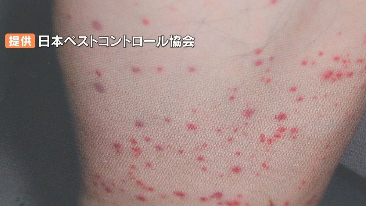 トコジラミ 刺された跡 画像