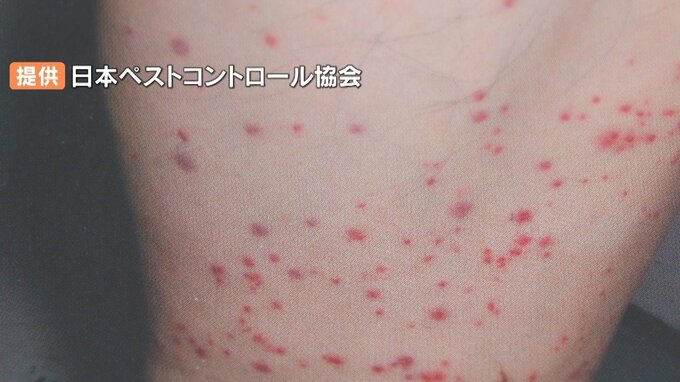 トコジラミ国内で被害相次ぐ　知らぬ間に荷物や衣類に…強い繁殖力でかまれると痒みや発疹　インバウンド増加で上陸か|TBS NEWS DIG