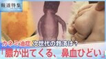 “黒い赤ちゃん”その後も・・・カネミ油症、次世代が訴える症状【報道特集】|TBS NEWS DIG