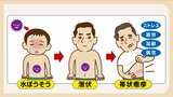 「感染力強く流行しやすい」 水ぼうそう感染者が増加 福岡 | 福岡のニュース|RKB NEWS|RKB毎日放送