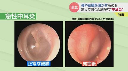 徐々に周りの骨を溶かして…」放っておくと危険な “中耳炎” 子どもから