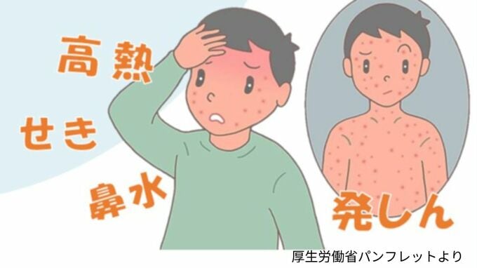 「はしか」患者　県内で3人感染確認　鹿児島県が注意呼びかけ【はしかの注意点と予防方法】|TBS NEWS DIG