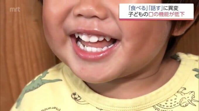 お口がぽかん  子どもの口腔機能発達不全症が全国で増加 昔ながらの遊び減少も原因に|TBS NEWS DIG