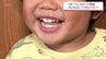 お口がぽかん  子どもの口腔機能発達不全症が全国で増加 昔ながらの遊び減少も原因に　|　MRTニュース ｜ ＭＲＴ宮崎放送