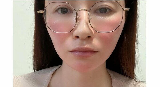 手島優さん　「顔がずっと赤い。。やだぁ」「アゴ先まで赤く」「触るとめちゃくちゃ熱い」　自身の「異変」明かす|TBS NEWS DIG