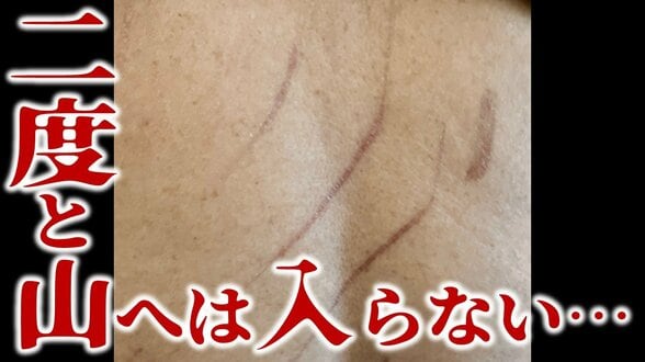 「走って逃げることなんてできなかった」クマに襲われた男性が語った当時の状況　「あっ」と思った瞬間に鋭い爪が『顔』や『背中』などに…　今も体に残る痛々しい傷跡「覆いかぶさる感じで身体の左側を…」　|　青森のニュース│ATV NEWS│青森テレビ