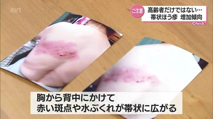 高齢者だけではない　帯状ほう疹が増加傾向・宮崎県　|　MRTニュース ｜ ＭＲＴ宮崎放送