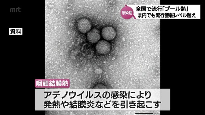 「プール熱」とも呼ばれる咽頭結膜熱が流行警報レベルに　|　MRTニュース ｜ ＭＲＴ宮崎放送