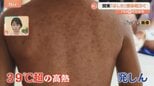 極めて感染力が強い「はしか」関東で報告相次ぐ 感染すると免疫がリセットされることも【Nスタ解説】 |TBS NEWS DIG