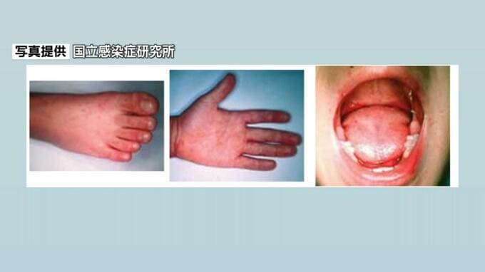 那覇市 手足口病警報を発表　県内全域ですでに警報レベル超のおそれ　|　沖縄のニュース｜RBC 琉球放送