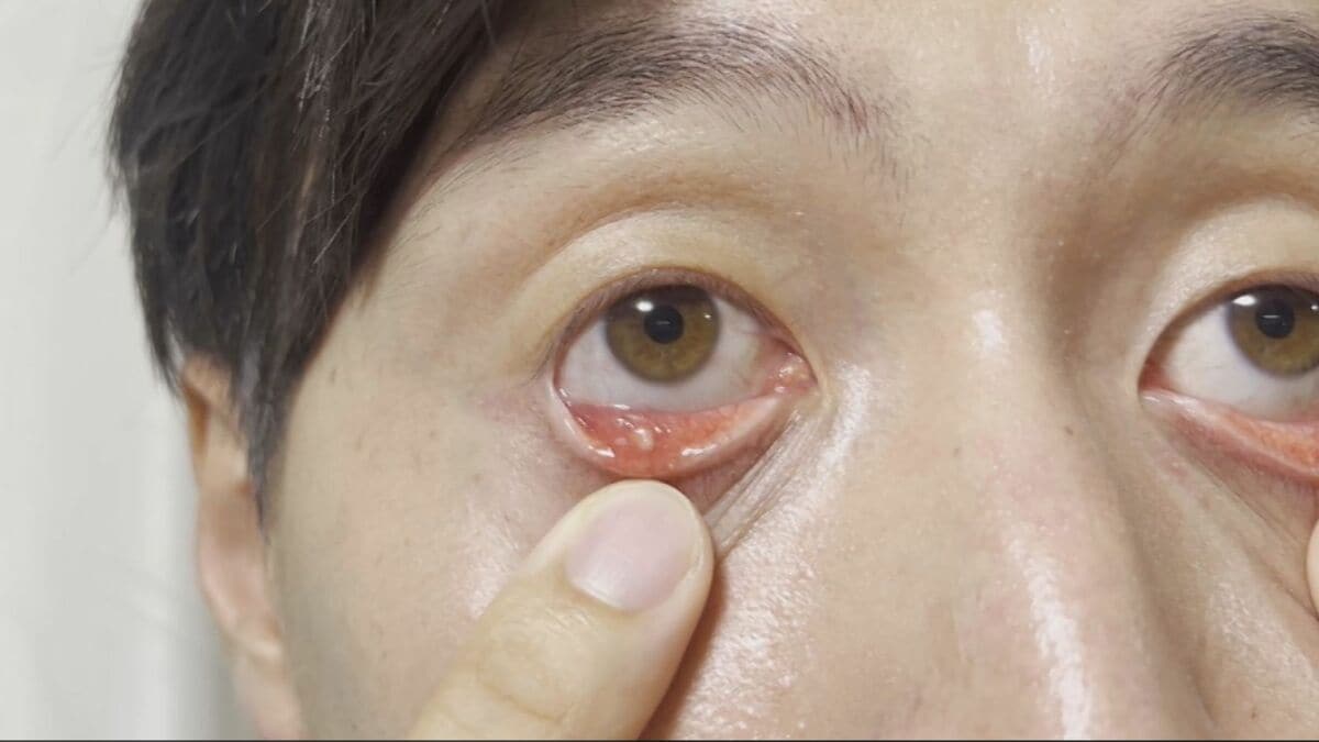 下 まぶた 白い でき もの