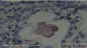 広島原爆の入市被爆者　70年後の体内からウラン検出　肺がん組織では「デスボール」確認　長崎大学研究グループ|TBS NEWS DIG