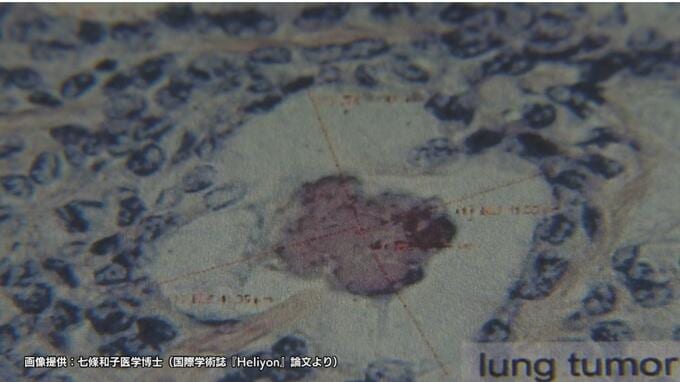 広島原爆の入市被爆者　70年後の体内からウラン検出　肺がん組織では「デスボール」確認　長崎大学研究グループ|TBS NEWS DIG