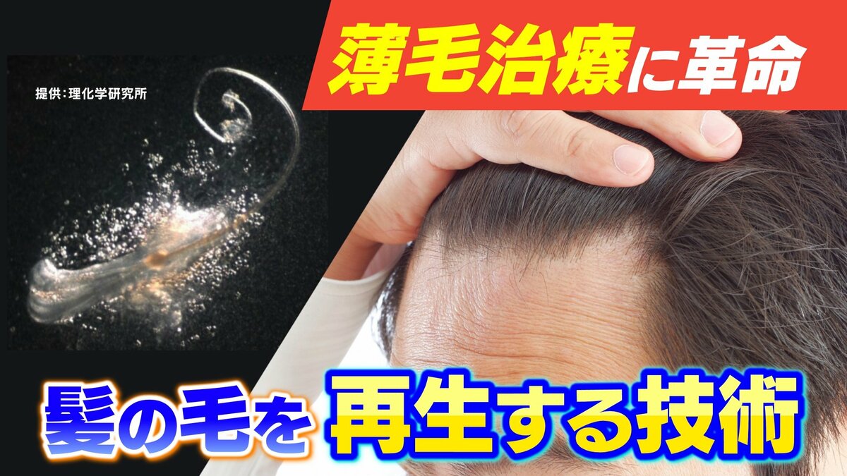薄毛治療に革命「1本の髪の毛が数百本に」髪の毛を作る “毛包” の再生を支える細胞を発見 再生医療への応用に期待 | TBS NEWS DIG ...