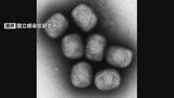 感染症「エムポックス」沖縄で3例目の感染確認 子どもや健康状態によっては重症化のおそれも | 沖縄のニュース|RBC 琉球放送