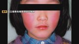 リンゴ病が流行の兆し 胎児に影響するケースも、妊婦は特に注意 マスク着用や手洗いで感染対策を | 大分のニュース|OBS NEWS|大分放送