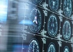 ロシュ、新治験薬でアルツハイマー「予防」目指す－第３相試験を計画| TBS CROSS DIG with Bloomberg