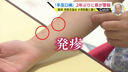 手足口病」感染拡大 広島県で2年ぶりに「警報」発令 小児科医「まずは