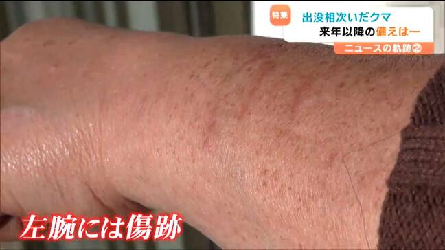 「熊と聞くだけで恐怖」左腕に残る引っかき傷 襲われた女性が語る後遺症「破傷風の注射、安定剤も飲んでいる」次の大量出没は2年後？  |TBS NEWS DIG