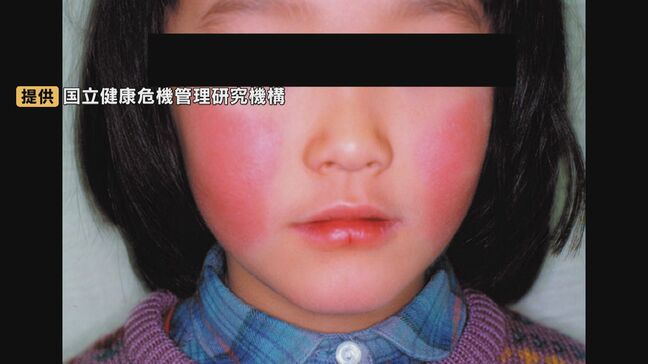 リンゴ病が流行の兆し 胎児に影響するケースも、妊婦は特に注意 マスク着用や手洗いで感染対策を|TBS NEWS DIG