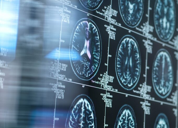 ロシュ、新治験薬でアルツハイマー「予防」目指す－第３相試験を計画