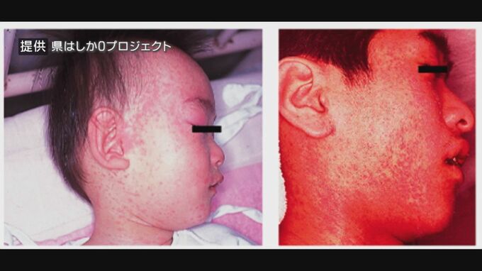 「マスクや手洗いでは防げない」重症化や死に至る、流行拡大する“はしか”　ワクチン接種を呼びかけ|TBS NEWS DIG