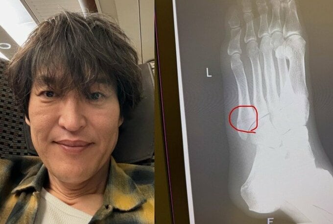 【 千原ジュニア 】左足を骨折「夜中起きてトイレ行く時足グネって、朝見たら足の甲パンパンに腫れてて」|TBS NEWS DIG