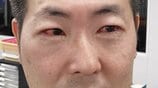 「何もできん」まぶた腫れ、大量の目やに…“はやり目”で社会生活が完全停止した　原因はプール熱と同じウイルス、24時間以上も生存　|　大分のニュース｜OBS NEWS｜大分放送